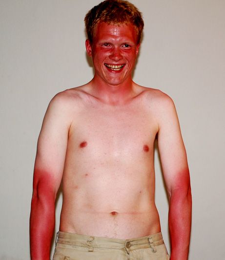 Severe Sunburn