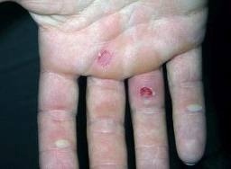 Windsurfing callouses – How to cure “holiday blisters”